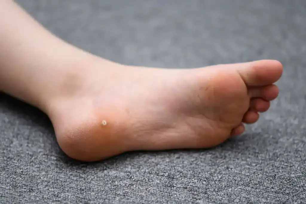Cryotherapy For Warts And Also Verrucas 2 Image of verruca on the bottom of the foot that able to be treated with Cryotherapy Wiltshire