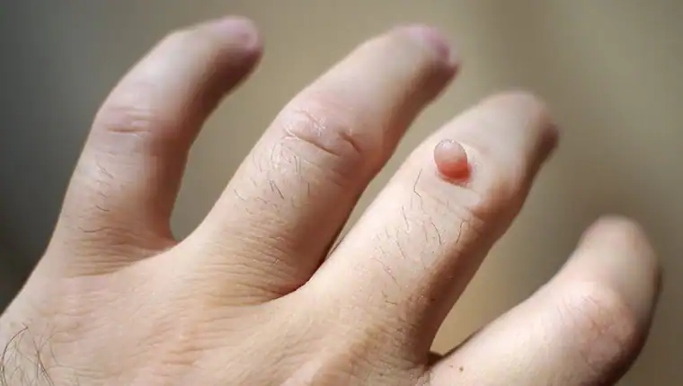Cryotherapy For Warts And Also Verrucas 1 Image of blemish that Cryotherapy Wiltshire can remove with Lipo 360.