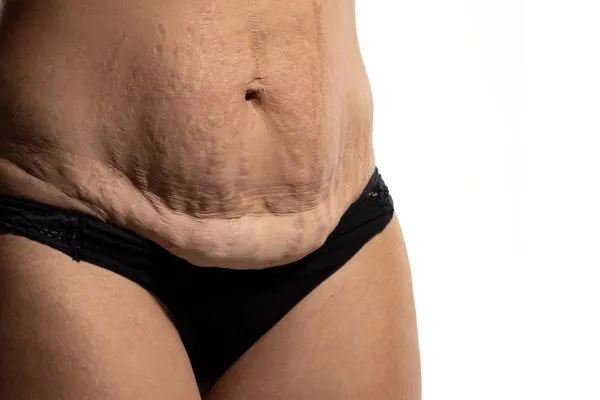 The Science of Skin Tightening 1 The science behind skin tightening Wiltshire picture of a woman's sagging skin on the stomach